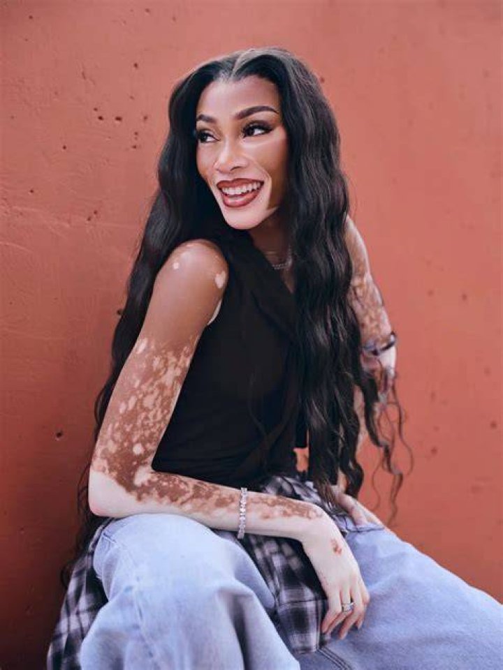 Winnie Harlow